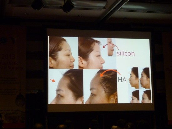 엄지원 필러/ 레스틸렌 비탈/ 물광주사/ 2013.4.28일 코엑스/ 대한미용성형외과학회 강연 / 김종서성형외과원장 관련 이미지 7