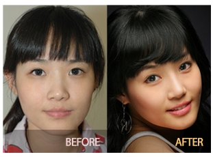 Sinsa-dong Eye Surgery - Speed Buried Suture Method / Double Eyelid Surgery image 5
