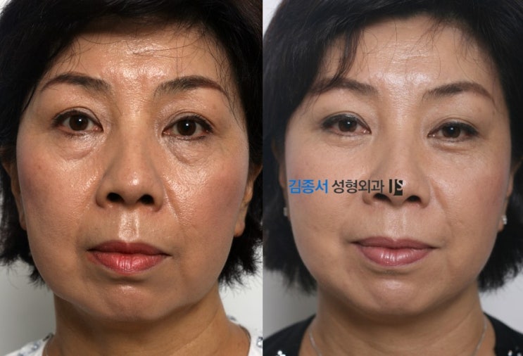 [눈밑지방제거] 눈밑지방, 눈밑지방제거 수술 / 김종서성형외과 관련 이미지 1