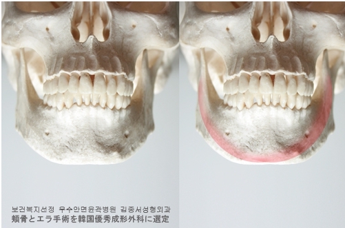 안면윤곽 최우수병원선정 ! 관련 이미지 5
