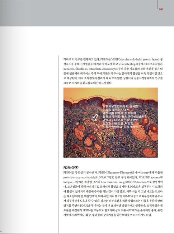 [메디컬S] 메디컬S 5월호 Stimulator 필러제 주사 후 PDRN 주사 비교 연구 관련 이미지 2