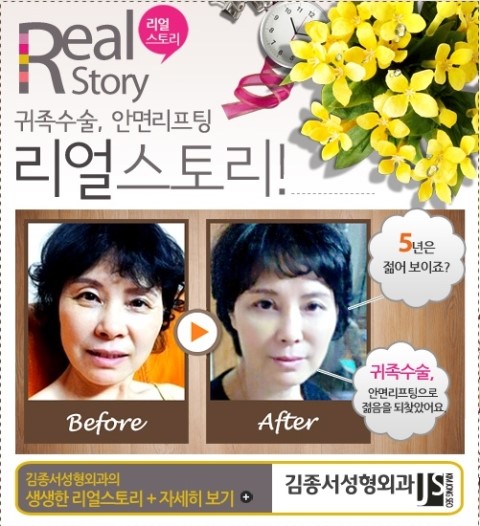 안면리프팅 이벤트 관련 이미지 3