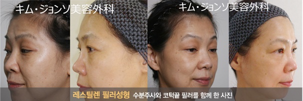 촉촉한 피부를 위한 물광주사 관련 이미지 6