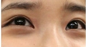 Lower Blepharoplasty at a Gangnam Plastic Surgery Clinic image 2
