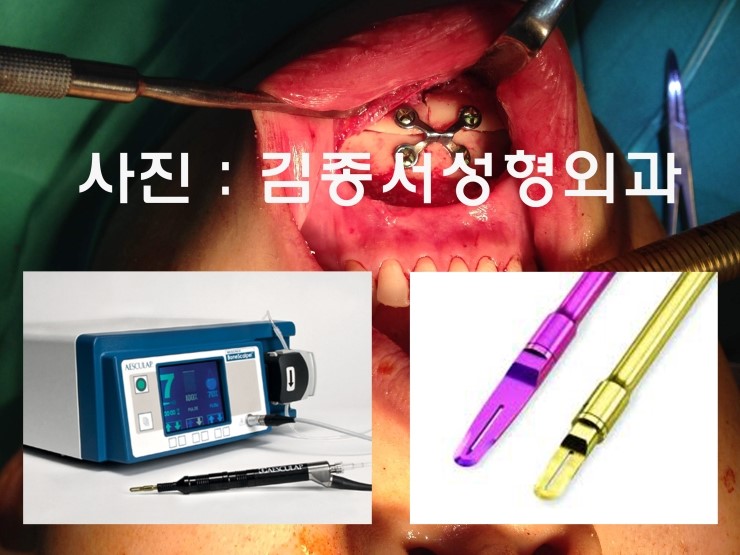 T Osteotomy / V-Line Square Jaw Surgery / Facial Contouring / Kim Jongseo Plastic Surgery, Selected as an Excellent Facial Contouring Hospital by the Ministry of Health and Welfare in 2009 image 4