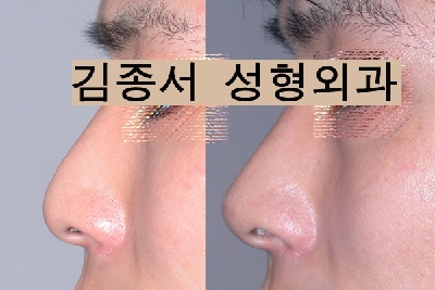 [김종서성형외과] 무통, 무부담 미리보고 하는 3차원 가상공동성형~ 관련 이미지 2