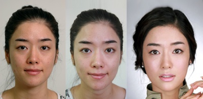 간단한 주사로 내 얼굴을 생기있게~ 김종서성형외과 <보톡스주사/필러주사> 관련 이미지 5
