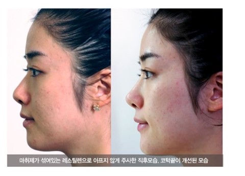 [알아두세요] 쁘띠성형 관련 이미지 5