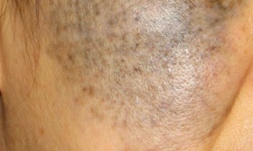 Sinsa-dong Plastic Surgery Clinic - Ota Nevus Treatment image 4