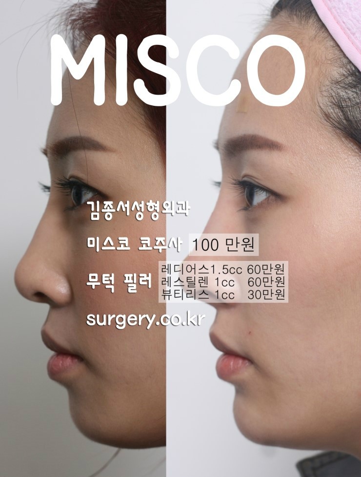 개방형코수술 / 미스코의 차이를 느껴보세요 / 김종서원장블로그 관련 이미지 2