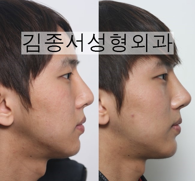 Nose Surgery: What Do You Want to Know? image 2