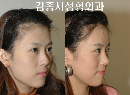 안면윤곽최우수병원- 김종서성형외과의 실리콘 이마성형술 관련 이미지 4