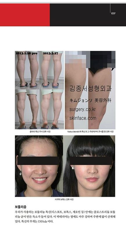 메디컬S 잡지 기사/ 보톡스 / 김종서성형외과원장 (디스포트,보톡스,주름,사각턱보톡스,종아리보톡스,승모근) 관련 이미지 5