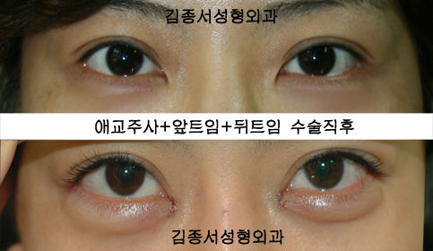 애교주사 앞트임 뒤트임 수술전후사진 (수술직후사진) 관련 이미지 1