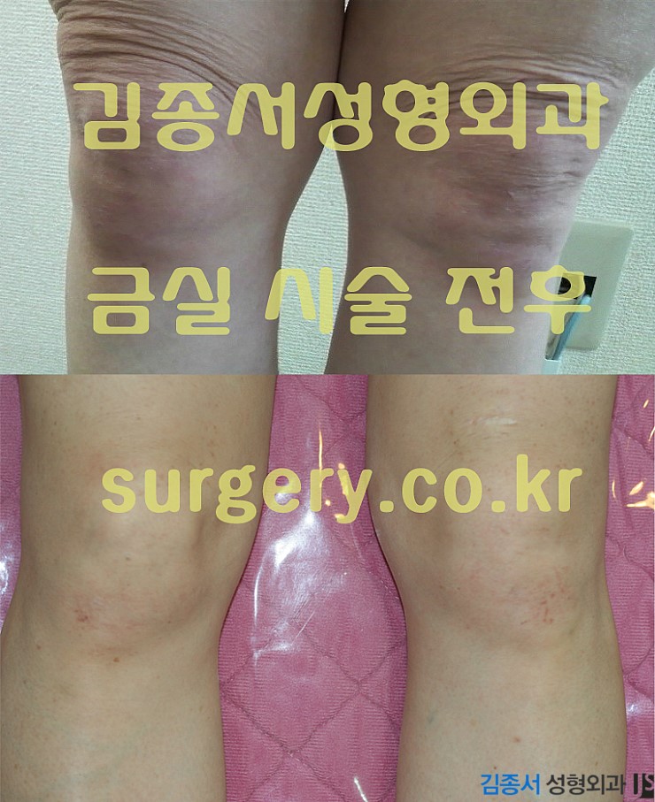 [리프팅] 금실리프팅 / 다리실리프팅 / 바디리프팅 / 효도성형 리프팅추천 관련 이미지 1