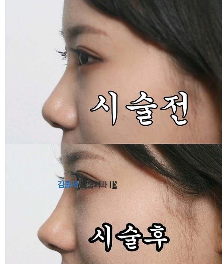 [미스코+필러] 미스코 필러후기 / 미스코 동영상 / 미스코 시술과정 / 김종서성형외과 관련 이미지 2