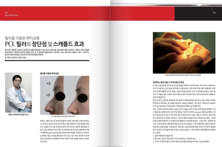 medical S 2013년 10월 PCL 필러의 장단점 및 스캐폴드 효과 관련 이미지 1