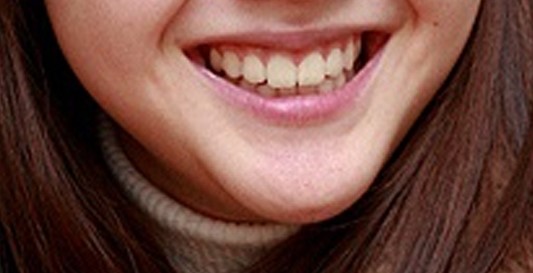 턱밑살제거주사 - 얼굴라인 주사 관련 이미지 1