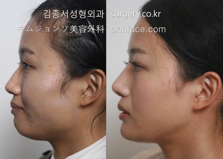 T Osteotomy / V-Line Square Jaw Surgery / Facial Contouring / Kim Jongseo Plastic Surgery, Selected as an Excellent Facial Contouring Hospital by the Ministry of Health and Welfare in 2009 image 1