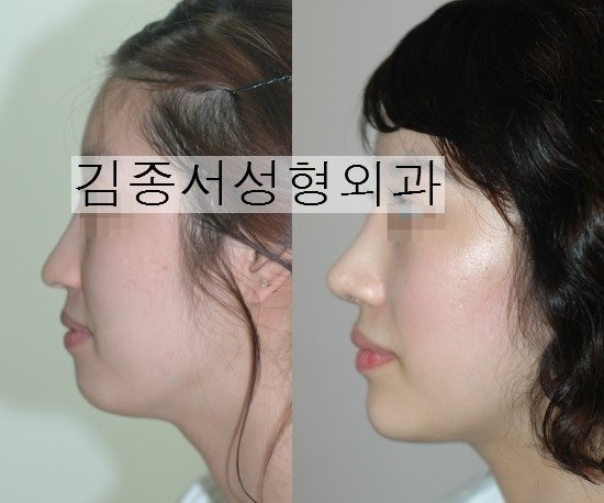 코성형 정보 확인! 관련 이미지 2