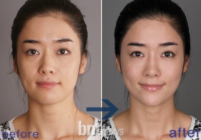 간단한 주사로 내 얼굴을 생기있게~ 김종서성형외과 <보톡스주사/필러주사> 관련 이미지 3