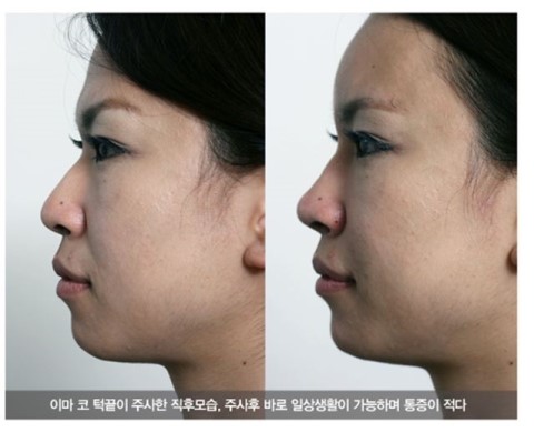 Introduction to Petite Cosmetic Procedures image 7
