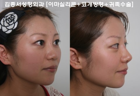 이마실리콘 성형수술은 안전한가요? / 김종서성형외과/ 이마성형 /안면윤곽/ 코수술 귀족수술 이마실리콘 코수술 개방형수술 관련 이미지 2