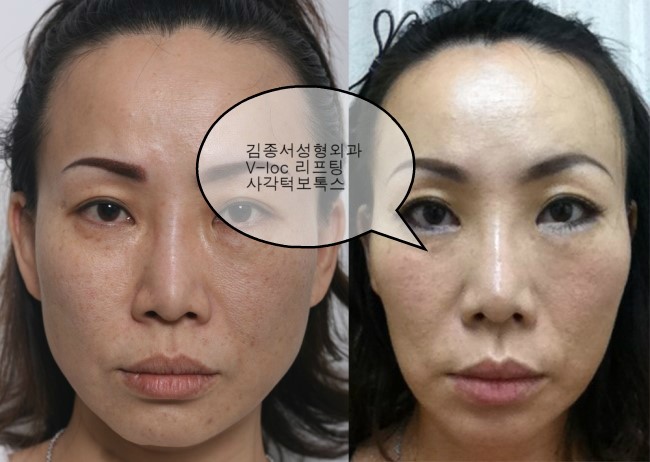 V-loc 리프팅과 사각턱 보톡스로 갸름해진 얼굴 사진 / 김종서성형외과/ 리프팅, 실루엣, 브이락, 성형, 주름, 실리프팅 관련 이미지 1