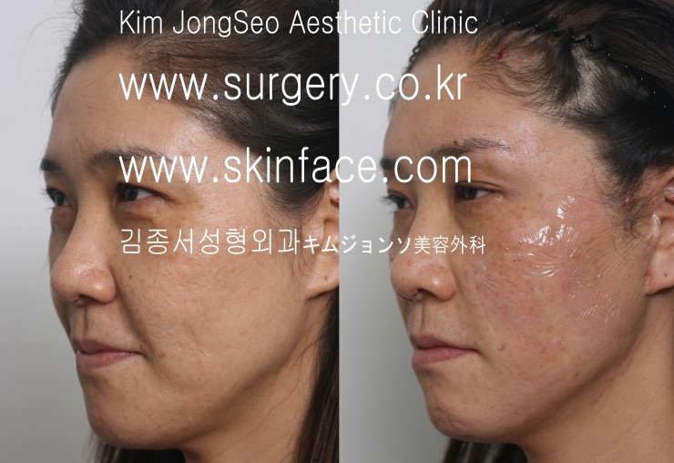 안면거상술 ( face lifting ) 실루엣리프팅 관련 이미지 1