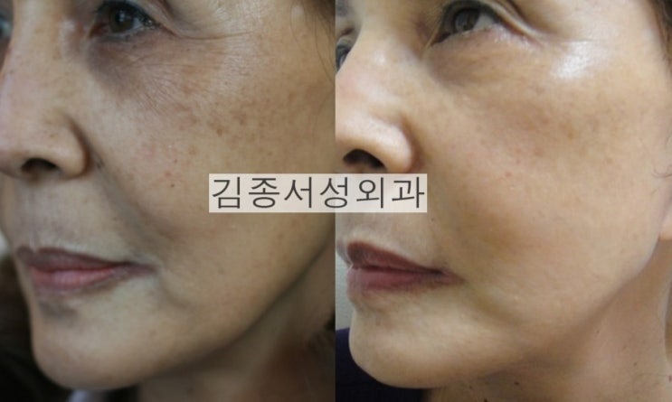 홍콩 레스틸렌 비탈 물광주사 개발 강의 후 한국 레티나지 소개 관련 이미지 13