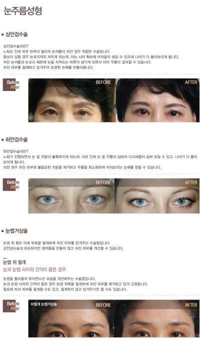 Eye Surgery, Complete Essential Information! image 3