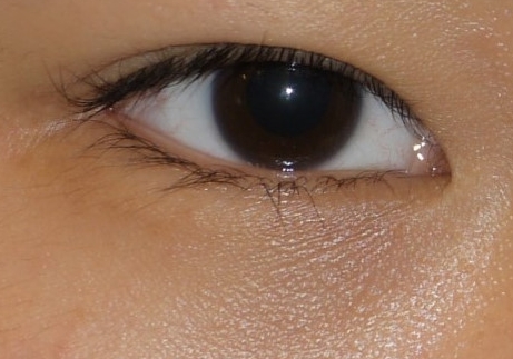 Under-Eye Ellansé image 2