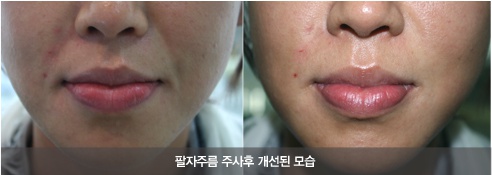 내 얼굴에 가장 잘 어울리는 필러성형은?~~~(restylane,레스틸렌,엘란쎄,Ellanse,Radiesse,래디어스,이마필러,이마성형) 관련 이미지 6