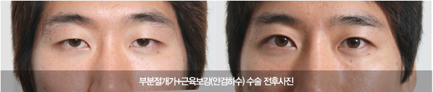또렷한 눈을 위한 눈성형 - 김종서성형외과 관련 이미지 10