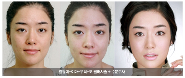 Sinsa-dong Restylane Vital - Pre-Wedding Bride Care image 3