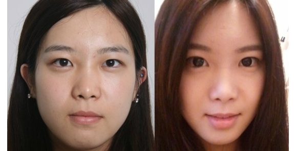 신사동성형외과 쌍커풀 재수술 관련 이미지 3