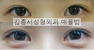 눈성형, 필수 정보! 관련 이미지 7