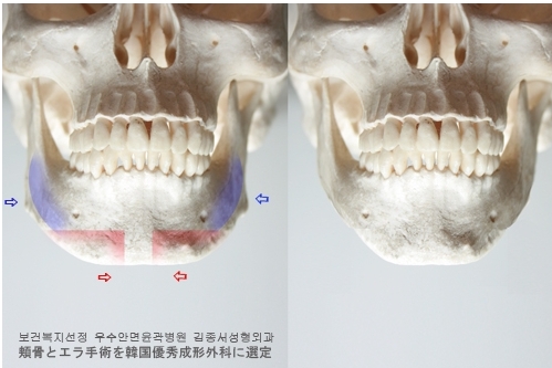 안면윤곽 최우수병원선정 ! 관련 이미지 6