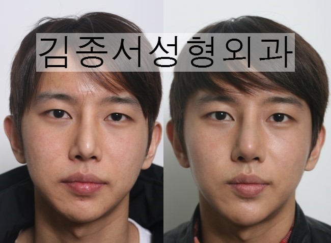 Nose Surgery: What Do You Want to Know? image 1