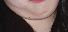 턱밑살제거주사 - 얼굴라인 주사 관련 이미지 2