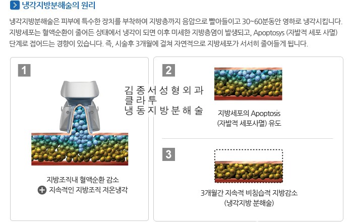냉동지방분해술, 클라투, 체험단모집 50만원>25원 김종서성형외과02-3416-0070 관련 이미지 3
