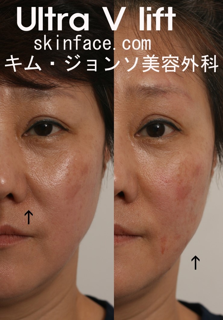 [울트라브이리프트] 김종서성형외과 관련 이미지 5
