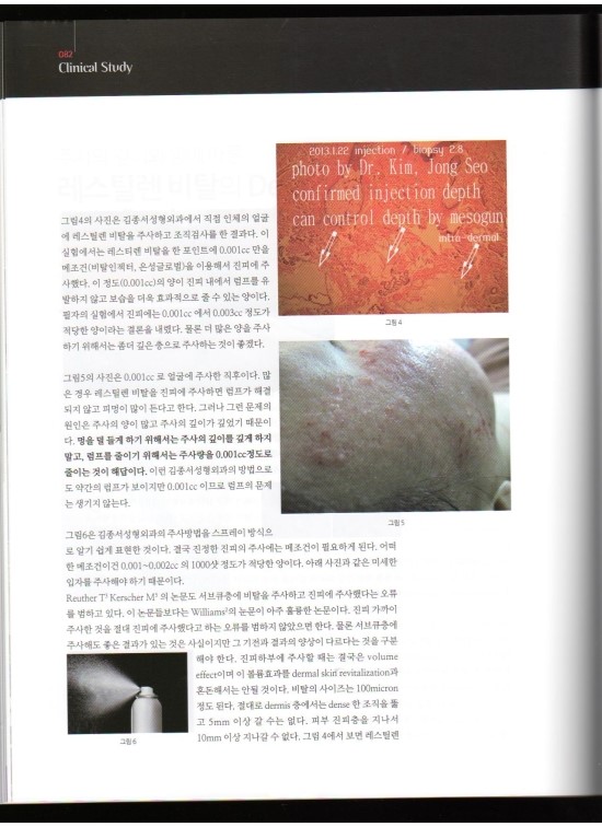 메디컬S 김종서성형외과 인터뷰/레스틸렌 비탈 엄지원필러/주름개선 물광주사 관련 이미지 4