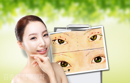 눈성형 필수정보 관련 이미지 5