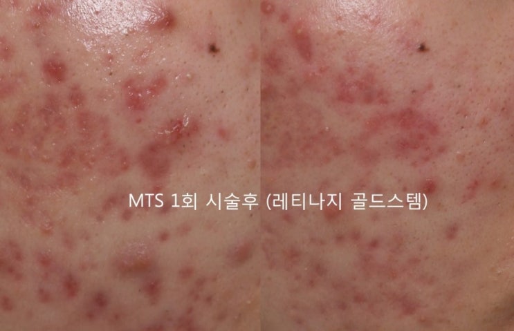 Acne Care / Acne Scar / Pore Care MTS (Retinage Goldstem) Before-and-After Photos After One Treatment image 2