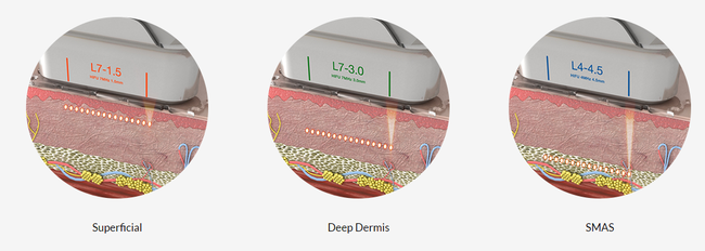 Take care of wrinkles and even the deeper layers of your skin with Shurink, evolved from Ultheraformer~ image 4