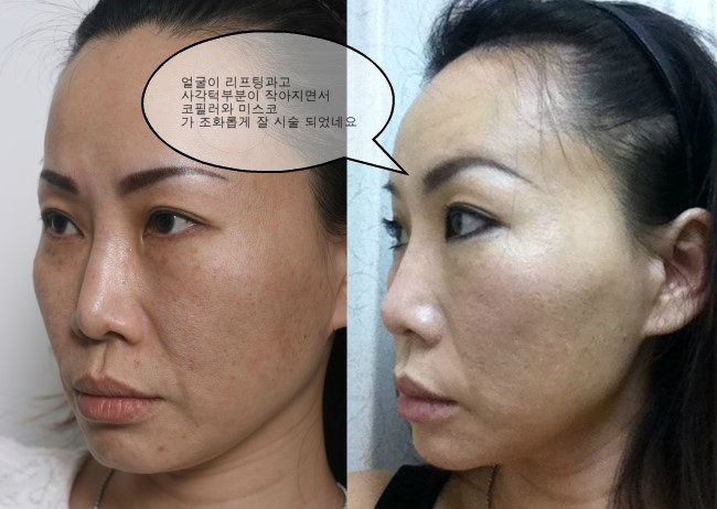 V-loc 리프팅과 사각턱 보톡스로 갸름해진 얼굴 사진 / 김종서성형외과/ 리프팅, 실루엣, 브이락, 성형, 주름, 실리프팅 관련 이미지 3