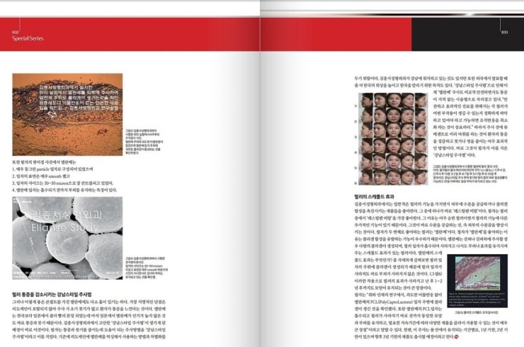 medical S 2013년 10월 PCL 필러의 장단점 및 스캐폴드 효과 관련 이미지 2