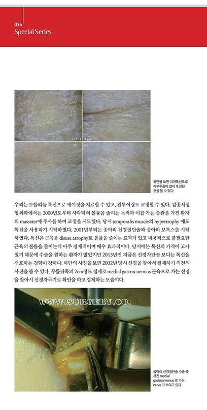 메디컬S 잡지 기사/ 보톡스 / 김종서성형외과원장 (디스포트,보톡스,주름,사각턱보톡스,종아리보톡스,승모근) 관련 이미지 4