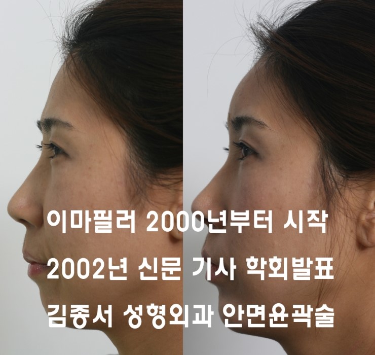이마 성형 2002년부터 연구발표, 수많은 신문 기사에 ..김종서성형외과/ 봉긋한 이마 /동안이마 관련 이미지 8